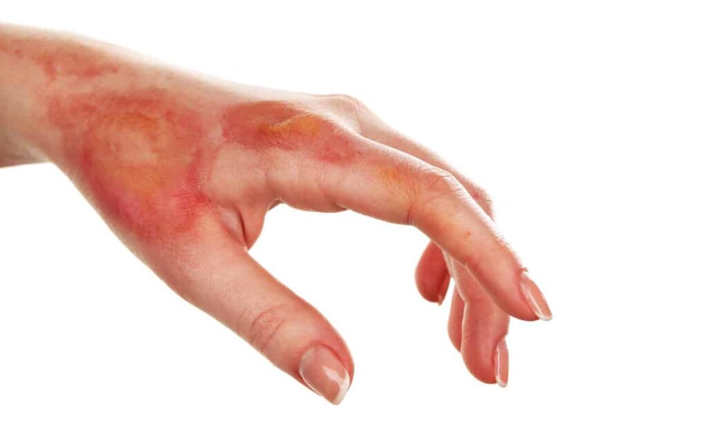 burn injury