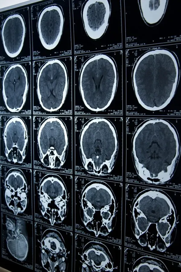 brain scans