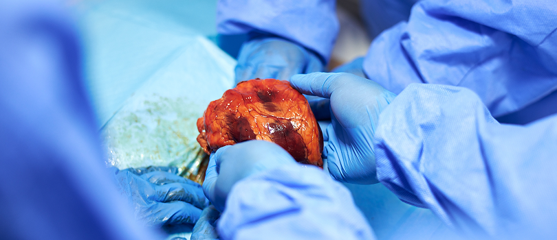 heart transplantation