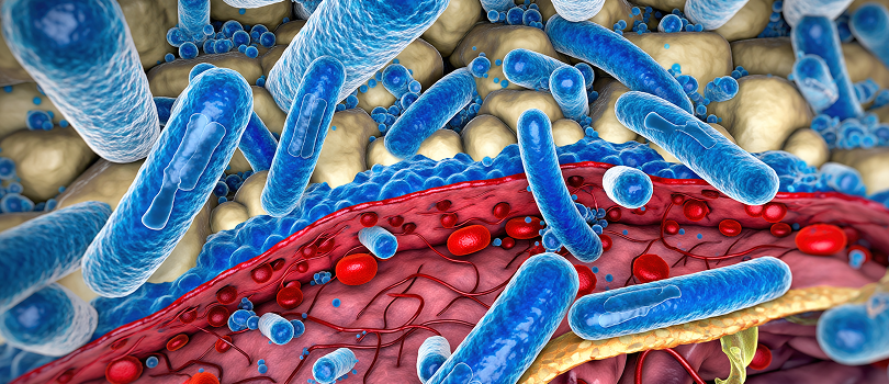 necrotizing fasciitis